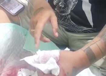 Gegara Benang Layangan, Jari Jempol Driver Ojol di Tabalong Nyaris Putus