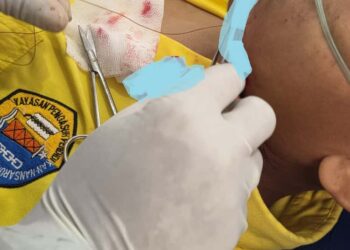 Benang Gelasan Layangan Kembali Memakan Korban, Dagu Anak Sekolah di Tabalong Robek