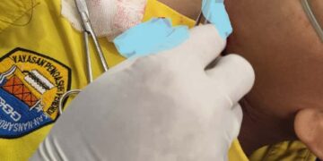 Benang Gelasan Layangan Kembali Memakan Korban, Dagu Anak Sekolah di Tabalong Robek